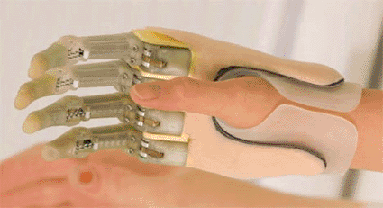 Image: The Prodigits Bionic Hand (Photo courtesy of Touch Bionics).